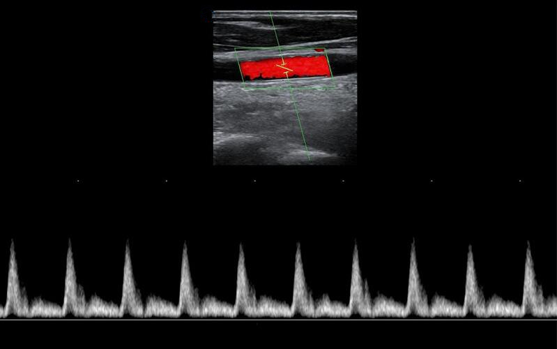 颈总动脉PW模式 u70t.jpg