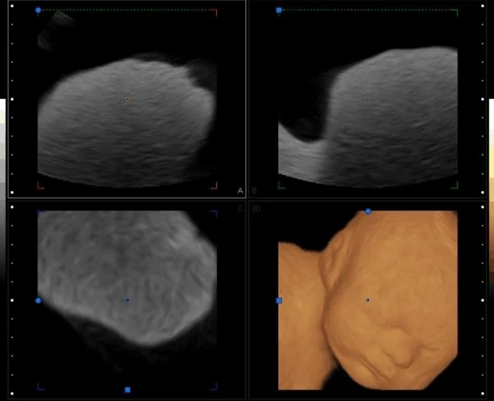 The Development History of Ultrasound two
